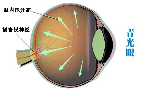 患青光眼為什么會致盲?